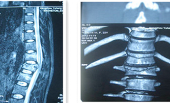 頸、胸、腰椎手術(shù)治療